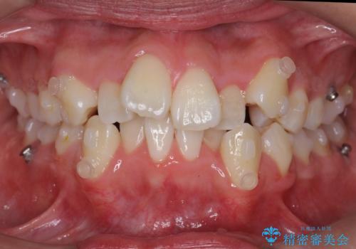 八重歯 抜かずにマウスピース矯正治療の治療中