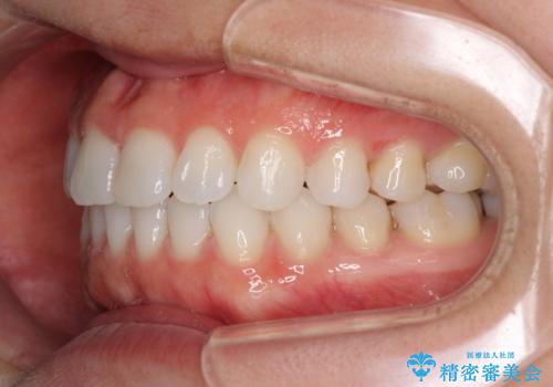 反対咬合を治したい インビザラインによる矯正治療の治療後