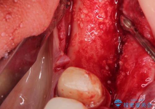骨が薄い部位への骨造成をともなうインプラントの治療中