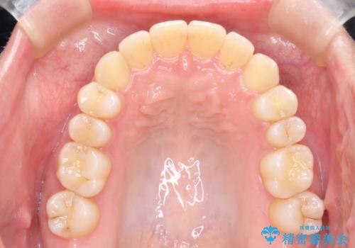 Invisalign インビザライン によるガタつき、受け口傾向の改善の治療後