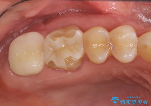 感染した奥歯 痛くて咬めない 根管治療→かぶせ物で痛みを取り除き、かみ合わせを回復するの治療前