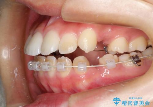 ハーフリンガル 半分裏側矯正による上下前突の抜歯矯正治療の治療中