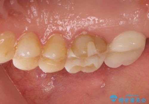 感染した奥歯 痛くて咬めない 根管治療→かぶせ物で痛みを取り除き、かみ合わせを回復するの治療前