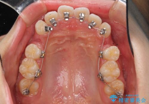 ハーフリンガル 半分裏側矯正による上下前突の抜歯矯正治療の治療中
