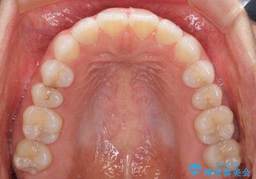 反対咬合を治したい インビザラインによる矯正治療の治療後
