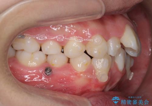 八重歯 抜かずにマウスピース矯正治療の治療中