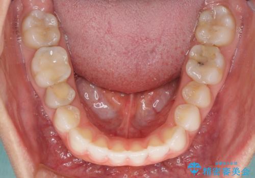 反対咬合を治したい インビザラインによる矯正治療の治療後