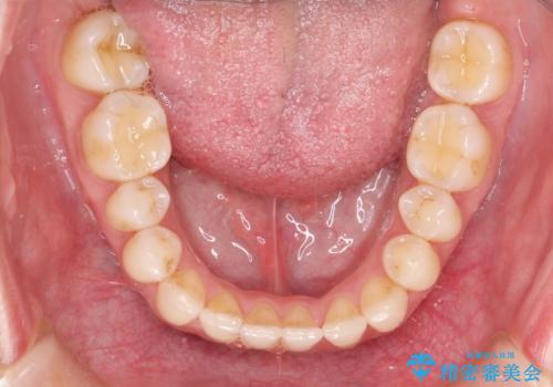 Invisalign インビザライン によるガタつき、受け口傾向の改善の治療後