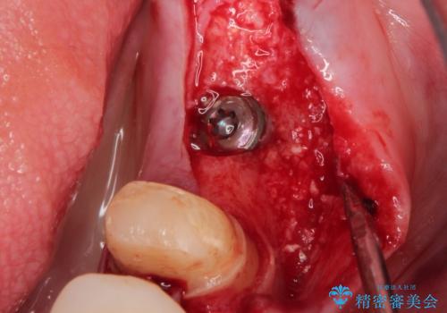 骨が薄い部位への骨造成をともなうインプラントの治療後
