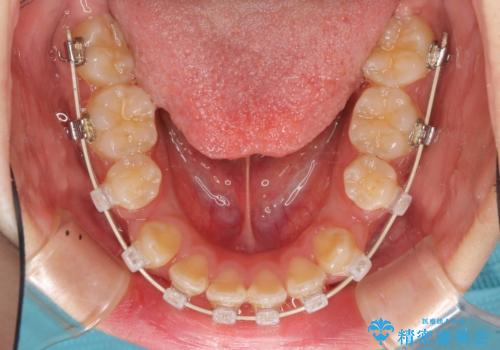 ハーフリンガル 半分裏側矯正による上下前突の抜歯矯正治療の治療中