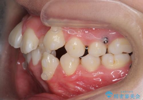 八重歯 抜かずにマウスピース矯正治療の治療中