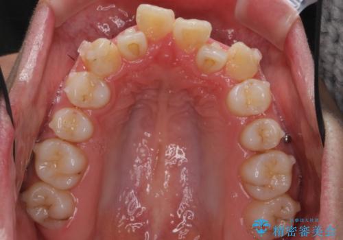 八重歯 抜かずにマウスピース矯正治療の治療中
