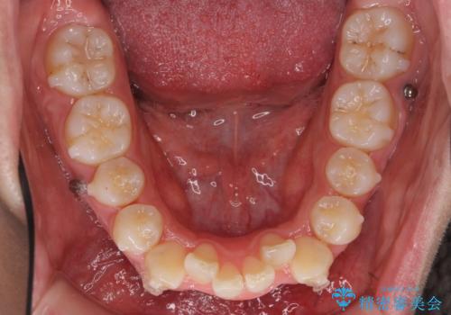 八重歯 抜かずにマウスピース矯正治療の治療中