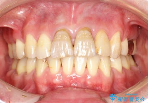 変色した前歯をセラミックできれいに　レイヤリングセラミックの治療前