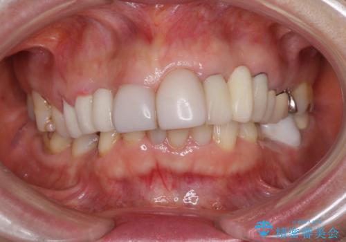 前歯をきれいに　部分矯正とオールセラミッククラウンの治療前
