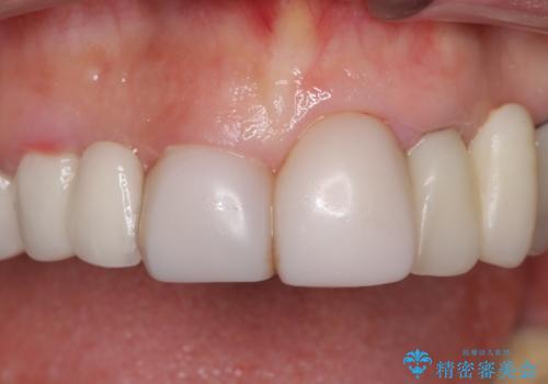 前歯をきれいに　部分矯正とオールセラミッククラウンの治療前
