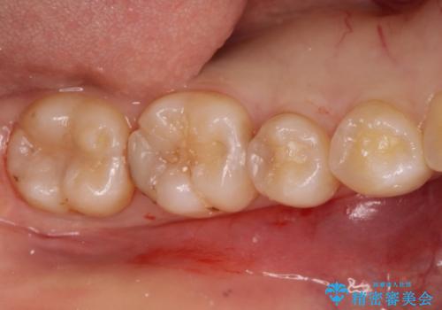 自然な見た目のセラミックインレーの治療前