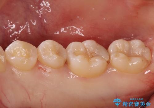 自然な見た目のセラミックインレーの治療前