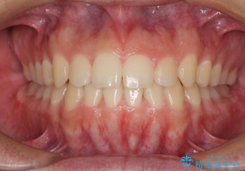 前歯のデコボコをワイヤー矯正で速やかに改善の症例 治療後