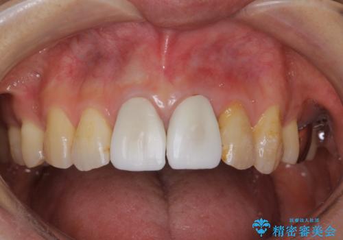 変色した前歯をセラミックできれいに レイヤリングセラミックの治療中