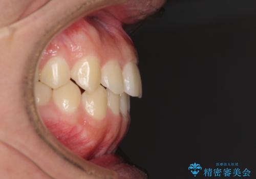 前歯のデコボコをワイヤー矯正で速やかに改善の治療後