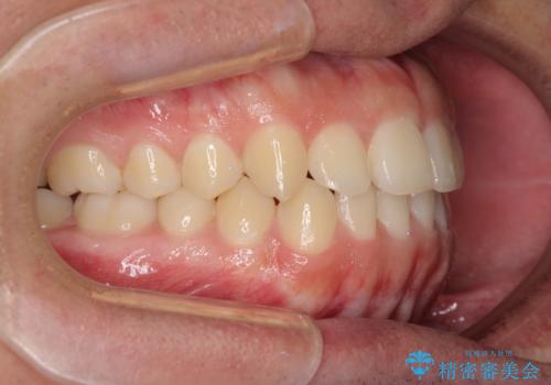 前歯のデコボコをワイヤー矯正で速やかに改善の治療後