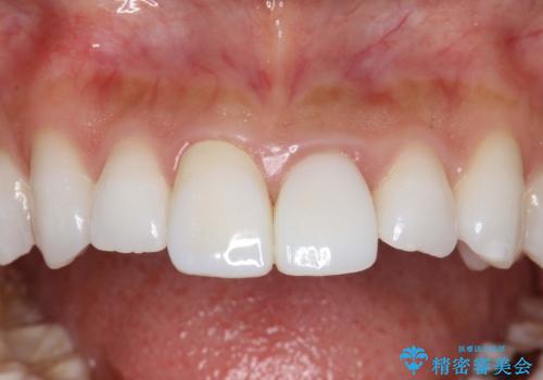 前歯の長さを揃える　歯周外科とセラミックの治療前