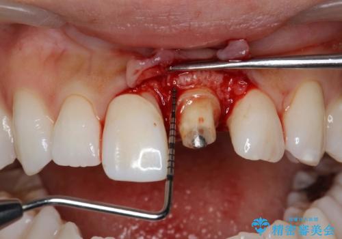 前歯の長さを揃える　歯周外科とセラミックの治療中