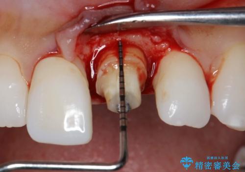 前歯の長さを揃える　歯周外科とセラミック
