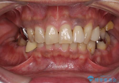奥歯で物を噛めるようにしたい 入れ歯による咬合回復の症例 治療前