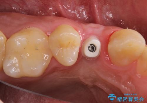 インプラントによる咬合回復の治療中