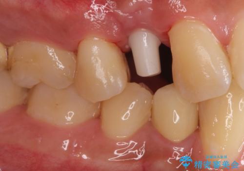 インプラントによる咬合回復の治療中