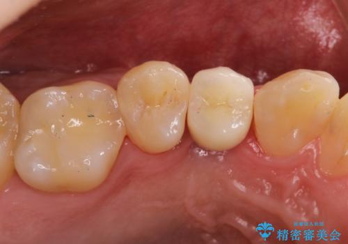 インプラントによる咬合回復の治療後