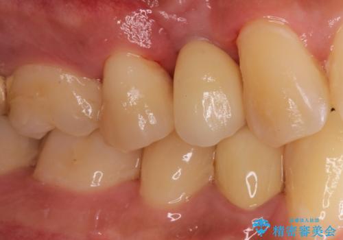 インプラントによる咬合回復の治療後