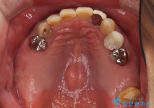 奥歯で物を噛めるようにしたい 入れ歯による咬合回復の治療前