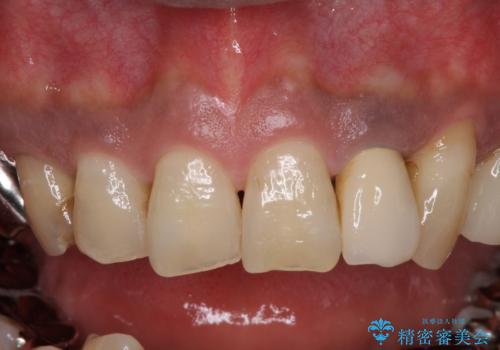 奥歯で物を噛めるようにしたい 入れ歯による咬合回復の治療前