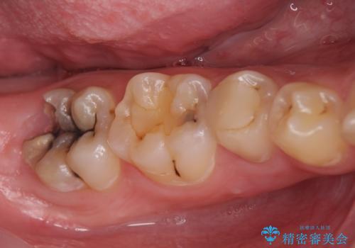 オールセラミッククラウン　歯肉より深い虫歯の治療の症例 治療前