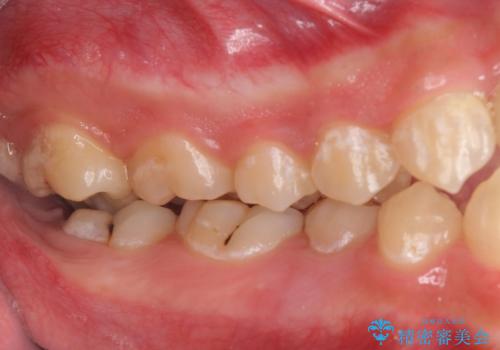 オールセラミッククラウン　歯肉より深い虫歯の治療の治療前