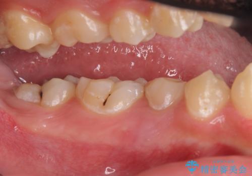 オールセラミッククラウン　歯肉より深い虫歯の治療の治療前