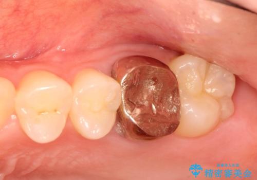 金属の奥歯　→　白い奥歯　根管治療からのやり直しの治療前