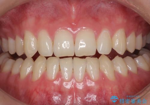 モチベーションの上がる白い歯にの症例 治療前