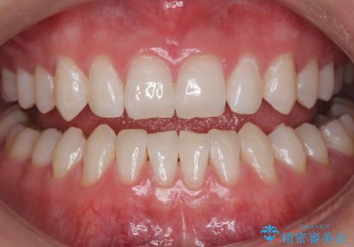 モチベーションの上がる白い歯にの症例 治療後