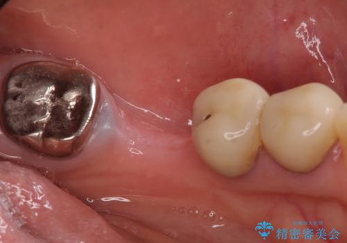 骨が薄い部位への骨造成をともなうインプラントの治療前