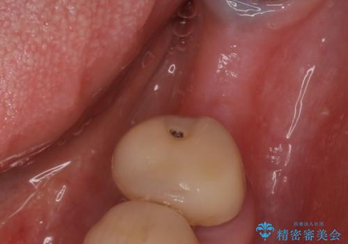 骨が薄い部位への骨造成をともなうインプラントの治療前