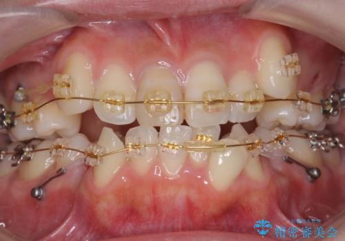 八重歯 前歯のがたがた 抜歯してワイヤー矯正の治療中