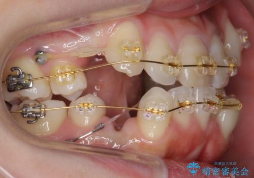 八重歯　前歯のがたがた　抜歯してワイヤー矯正の治療中