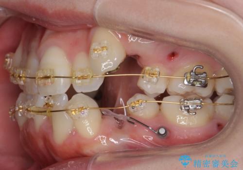 八重歯 前歯のがたがた 抜歯してワイヤー矯正の治療中