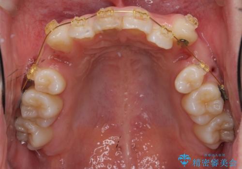 八重歯　前歯のがたがた　抜歯してワイヤー矯正の治療中