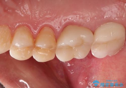 感染した奥歯 痛くて咬めない 根管治療→かぶせ物で痛みを取り除き、かみ合わせを回復するの治療後