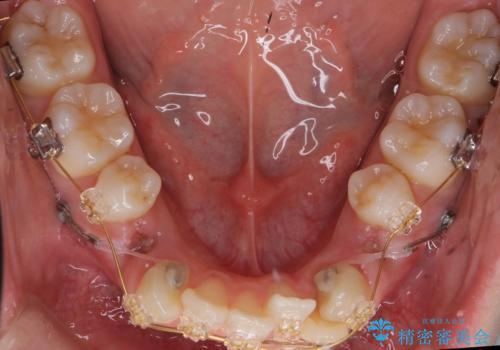 八重歯 前歯のがたがた 抜歯してワイヤー矯正の治療中